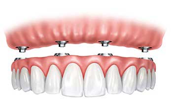 full mouth dental implants