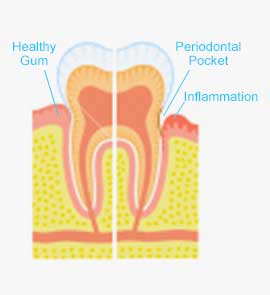 Illustration of periodontal disease